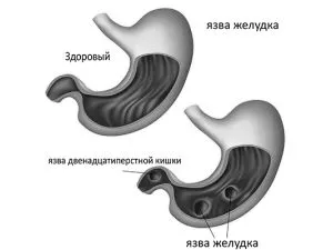 виразку