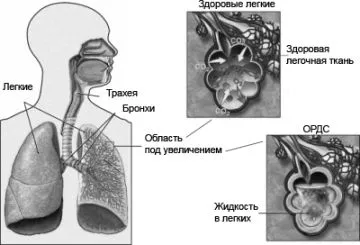 набряк легенів симптоми ознаки