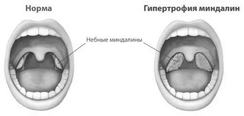 Як вилікувати пухкі мигдалини у дитини? як лікувати гланди у дитини народними засобами