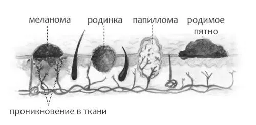 папілом