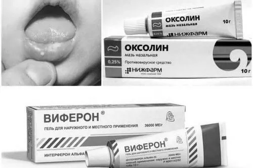 оксолінова мазь проти стоматиту