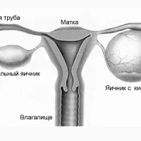 міхур