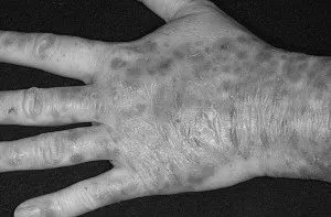 псоріазу
