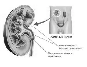Кальцинати в нирках: симптоми, діагностика та лікування лікування