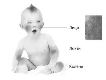 Лікування діатезу у немовлят немовлят