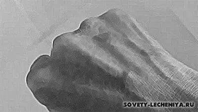 захворювання