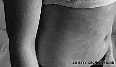 псоріаз