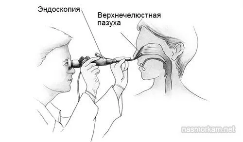 кіста