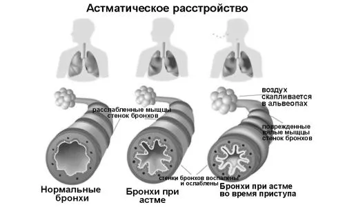 бронхіальної