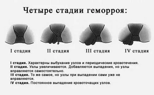 геморой