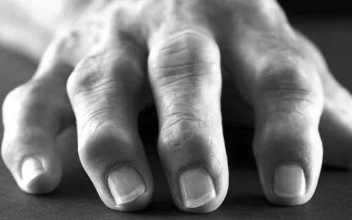 Лікування бурситу як довго лікувати бурсит