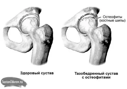 суглоба