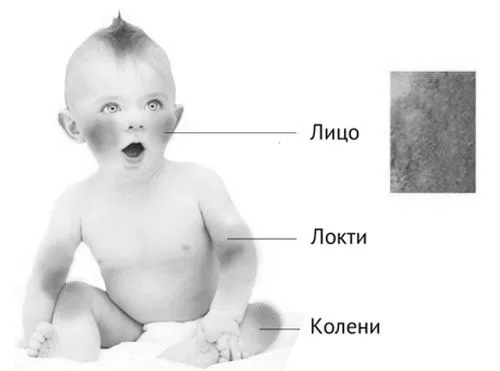 дерматит