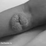 Лікування папілом чистотілом лікування
