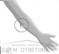 жировик