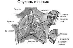 лікування
