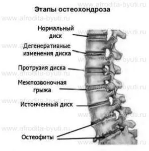 остеохондроз