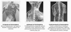 Лікування остеохондрозу на різних стадіях остеохондрозу