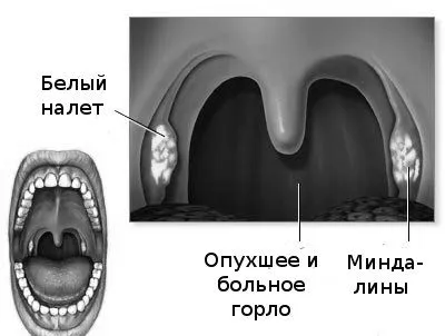кріотерапія в лікуванні тонзиліту