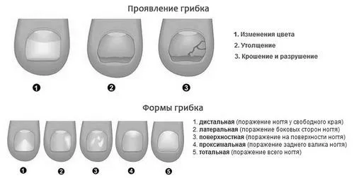 лікувати грибок нігтів часником