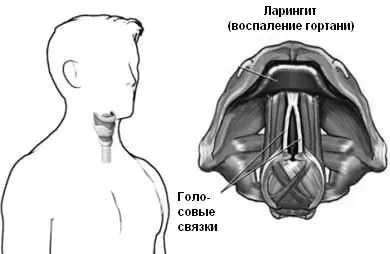Народне лікування ларингіту, методи швидко вилікувати хворобу методи