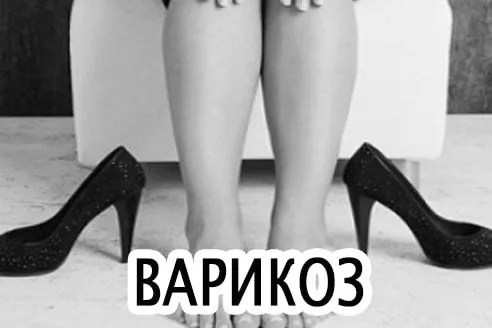 Настоянка каланхое при варикозі: рецепт при варикозному розширенні вен настоянка