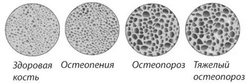 Нове лікування остеопорозу лікування артрозу