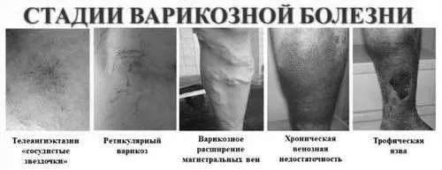 варикоз