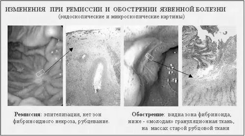 виразки