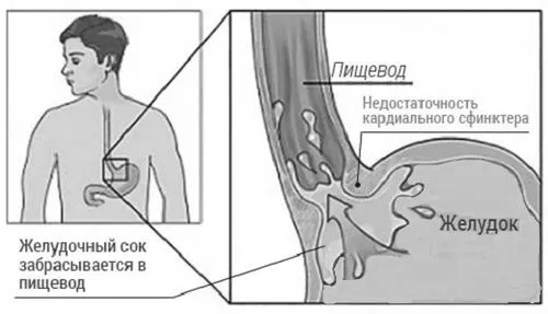 недостатність кардії шлунка симптоми
