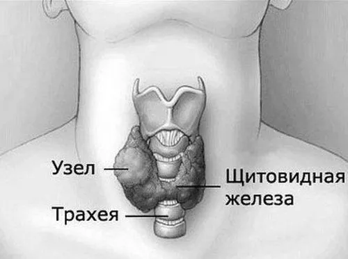 багатовузловий зоб щитовидної залози симптом лікування діагностика