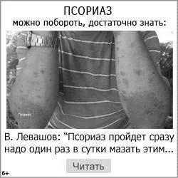 псоріаз