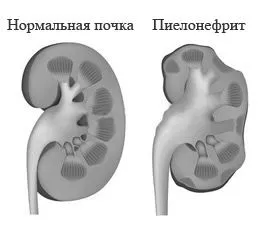 пієлонефрит