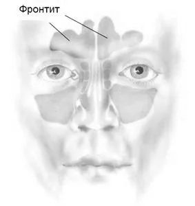 фронтит