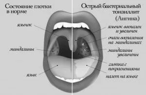 ангіни