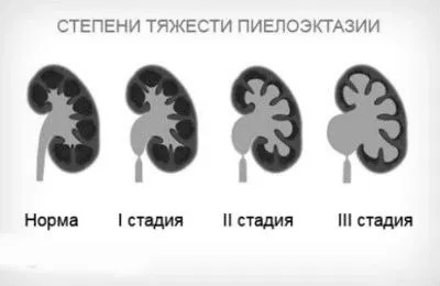 як лікувати розширення нирки