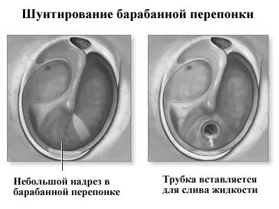 отит