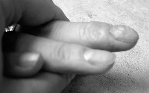 чому нігті на руках стали хвилястими лікування