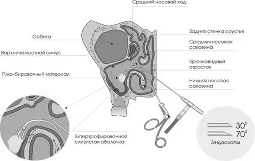 хронічний гайморит операція
