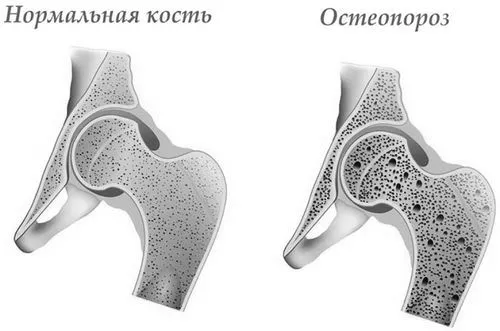 остеопороз