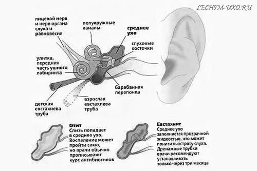 отит