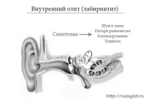 як лікувати отит носа