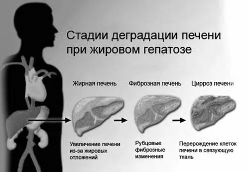 Ожиріння печінки: симптоми, діагностика, лікування печінки