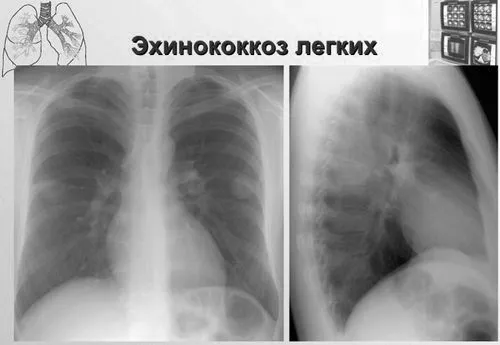 легенях