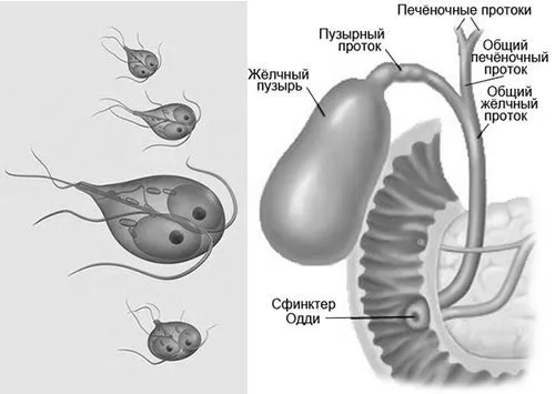 як лікувати лямблії в жовчному міхурі