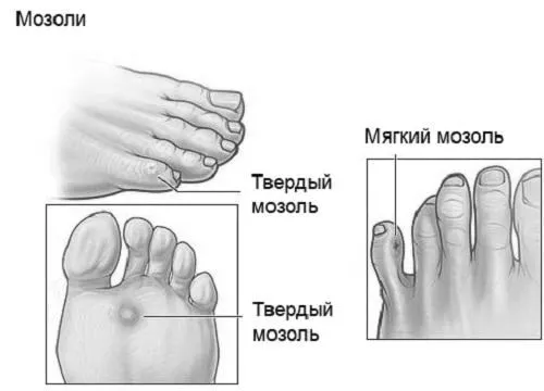 мозолі