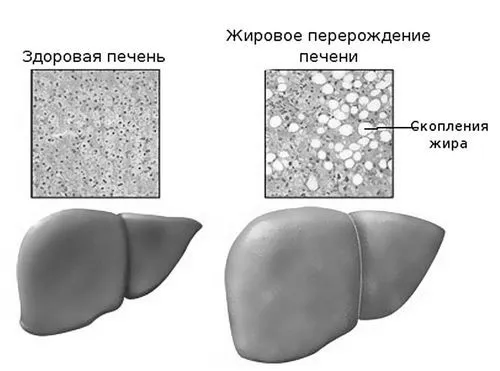Ожиріння печінки: симптоми, діагностика, лікування як вилікувати ожиріння печінки народними засобами
