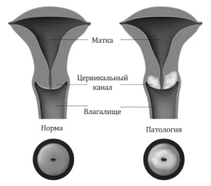 матки