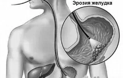 як лікувати ерозію шлунка народними засобами