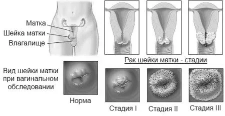 шийки